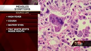 Two Measles Cases Confirmed [upl. by Dianna]