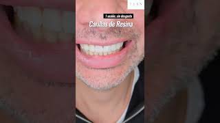 Transforma tu Sonrisa con Carillas de Resina  Clínica ESAN [upl. by Navannod]