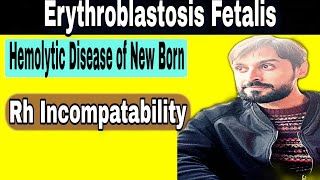 Erythroblastosis fetalis  Rh Incompatibility  Hemolytic Disease of New Born [upl. by Orsini313]