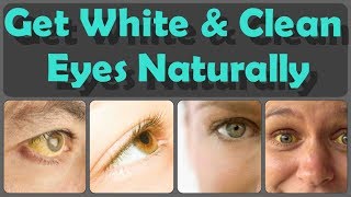 How To Get Clean Eyes Top 10 Methods For Whitening Of Eyes And 10 Foods For Yellow Eyes [upl. by Figge918]