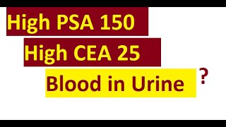 Explain PSA 150 CEA 25 Bloody urine meaning [upl. by Manon974]