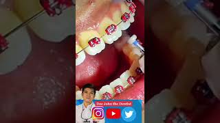 ENAMELOPLASTY Lagaring Ngipin paano inaayos [upl. by Sanoy389]