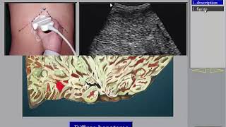 Ultrasound of the Liver HCC 2 in Arabic أورام الكبد [upl. by Vins]