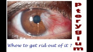 what is pterygium How to get rid out of it Hindi [upl. by Naujit821]