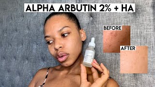 The Ordinarys Alpha Arbutin 2  HA Review  Fade Dark Spots Fast [upl. by Rehtae]