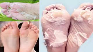 How to Get Rid of Peeling Skin on Your Feet [upl. by Kraus]