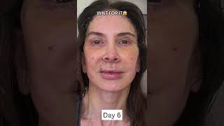 INSANE 2Week Facelift Healing and Recovery Process [upl. by Lamhaj830]