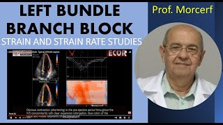 STRAIN ON LEFT BUNDLE BRANCH BLOCK LBBB [upl. by Nayhr]