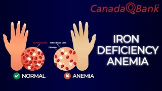 Iron Deficiency Anemia [upl. by Lillis4]