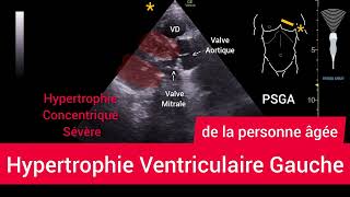 Hypertrophie Ventriculaire Gauche HVG Left Ventricular Hypertrophy Échographie [upl. by Cosme742]