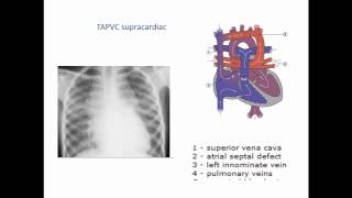 Total and Partial Anomalous Pulmonary Venous conne [upl. by Shererd]