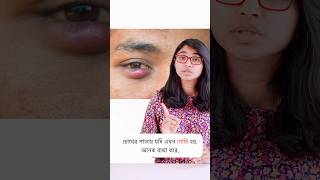 চোখের পাতায় অঞ্জনি হলে করণীয় [upl. by Ztnarf]