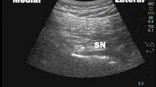 Unintentional sciatic nerve block following pudendal nerve block [upl. by Noemi]