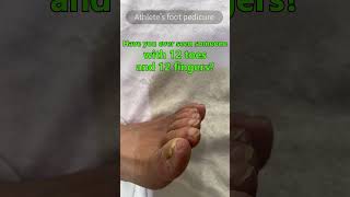 Have you ever seen someone with 12 toes and 12 fingers athletesfoot pedicure foot toes fingers [upl. by Nomrej]