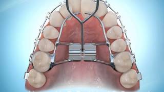 Hyrax Rapid Palatal Expansion Braces During [upl. by Sldney]