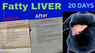 Fatty Liver Treatment  symptoms tamil medicine Fatty Liver  Dr Aravind homeopathy [upl. by Caton]