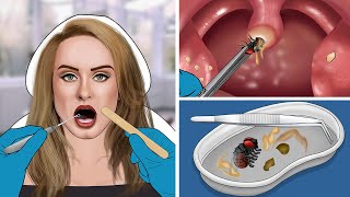 ASMR Remove The Fly amp Tonsil Stone From Adeles Throat [upl. by Deidre]