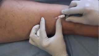 SyrEase Foam Sclerotherapy [upl. by Ahsilef]