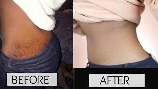 HOW TO GET RID OF STRETCH MARKS amp SCARS FAST [upl. by Ecnerol]