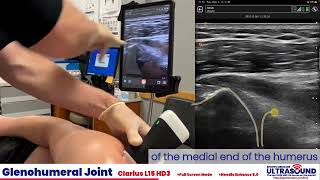 Glenohumeral Joint Injection Demonstration [upl. by Alberic]