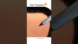 Hair transplant surgery animation short video [upl. by Brynne]