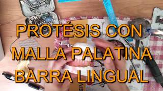 Prótesis dental con malla palatina y barra lingual [upl. by Brendis]