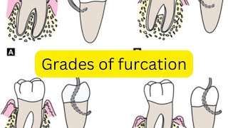 Grades of furcation involvement MADE EASY [upl. by Vanhomrigh47]