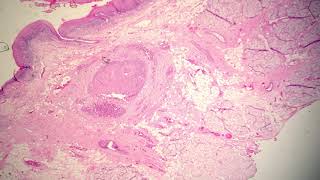 Well Differentiated Squamous Cell Carcinoma Verrucous Type [upl. by Spatola313]