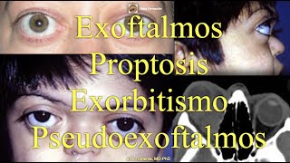 Proptosis Exoftalmos Exorbitismo y Pseudoexoftalmos [upl. by Loy]