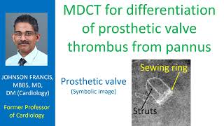 MDCT for differentiation of prosthetic valve thrombus from pannus [upl. by Nicko835]