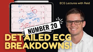 EKG Test Yourself  ECG Case Study 20 [upl. by Seroled654]