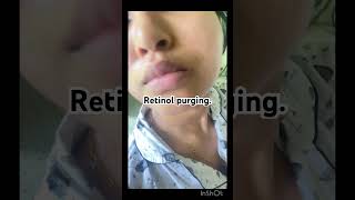 Retinol purging shorts youtubeshorts trendysong retinol skincare purging skincaretips acne [upl. by Yenreit]