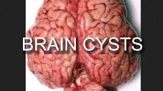 Brain Cyst Removal Arachnoid Cyst Everything You Need to Know [upl. by Shanta]