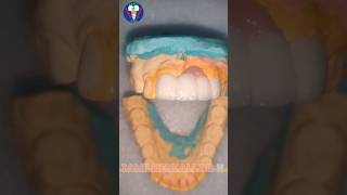 Ceramic Teeth  Upper Anterior  Maxillary Insicor  PFM  Tamil Dental Lab  tamildentist shorts🦷 [upl. by Blythe]