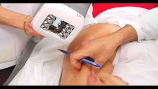 Dr Pierre Courchesne  Traitement de la cellulite  VelaShape [upl. by Adan]