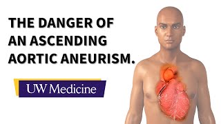 Surgeon describes an ascending aortic aneurysm  UW Medicine [upl. by Aldora]