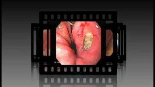 Animation of Gastrointestinal Endoscopy [upl. by Notsek]