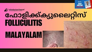 Folliculitis Malayalam sycosis barbaebarbers itchscalp folliculitis malayalam dr sujith karimbil [upl. by Arreit193]