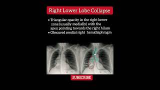 Right lower lobe collapse  Chest XRay  Radiology [upl. by Acirderf635]