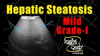 Mild Hepatic Steatosis  GradeI Fatty Liver  Ultrasound  Case 226 [upl. by Zabrine]