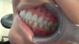 Intraoral Camera Demonstration [upl. by Eillas]