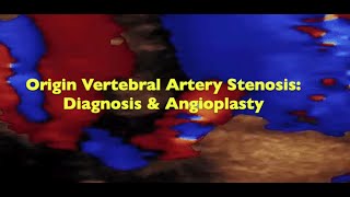 Origin Vertebral Artery Stenosis Diagnosis amp Angioplasty [upl. by Hall]