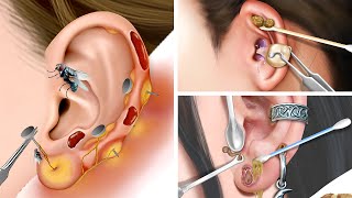 ASMR Treatment amp Remove dirty earrings worn for a long time flies flying into the ear deep cleaning [upl. by Isdnyl]