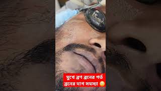 Acne scar acne spot acne problem solve in Bangladesh [upl. by Adnat]