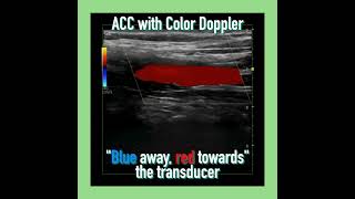 〖Echocardiography〗 Suprasternal view amp turbulent flow  subclavian steal syndrome [upl. by Anelyak303]