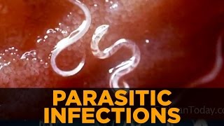 Parasitic Infections amp Symptoms From Parasites [upl. by Oniluap]