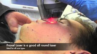 Fractional lasers [upl. by Freeborn]