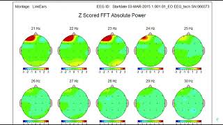 Estudio de encefalograma sobre los beneficios de las barras de access [upl. by Simpson525]