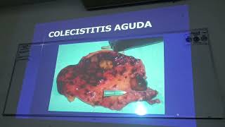 Clase Colecistitis Aguda [upl. by Stearns]