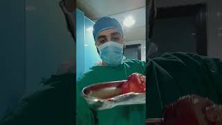 Subtotal hysterectomy with both ovaries removed due to excessive bleeding caused by fibroids [upl. by Mahan]